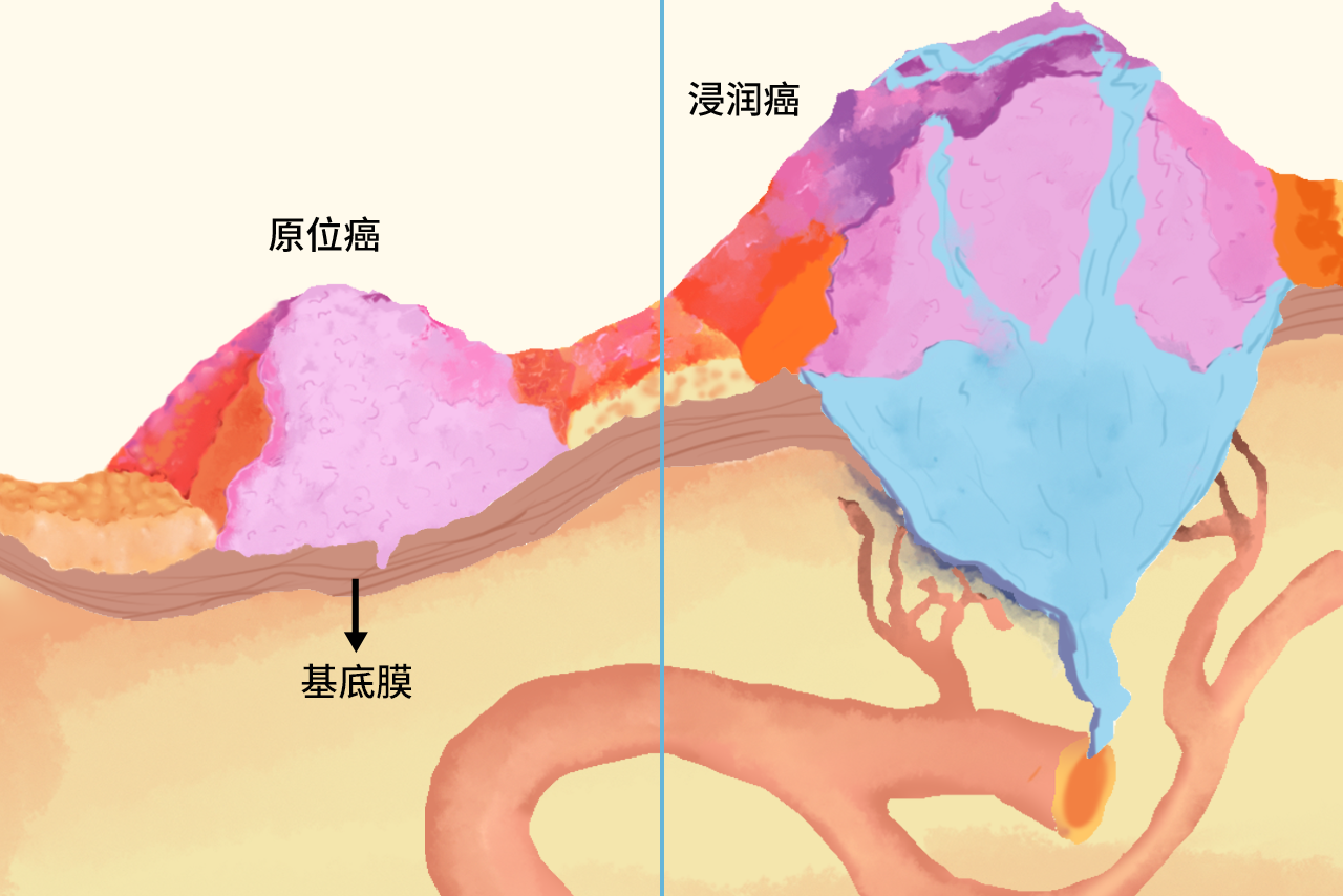 早期浸润癌长什么样子（早期浸润癌长什么样子图片）