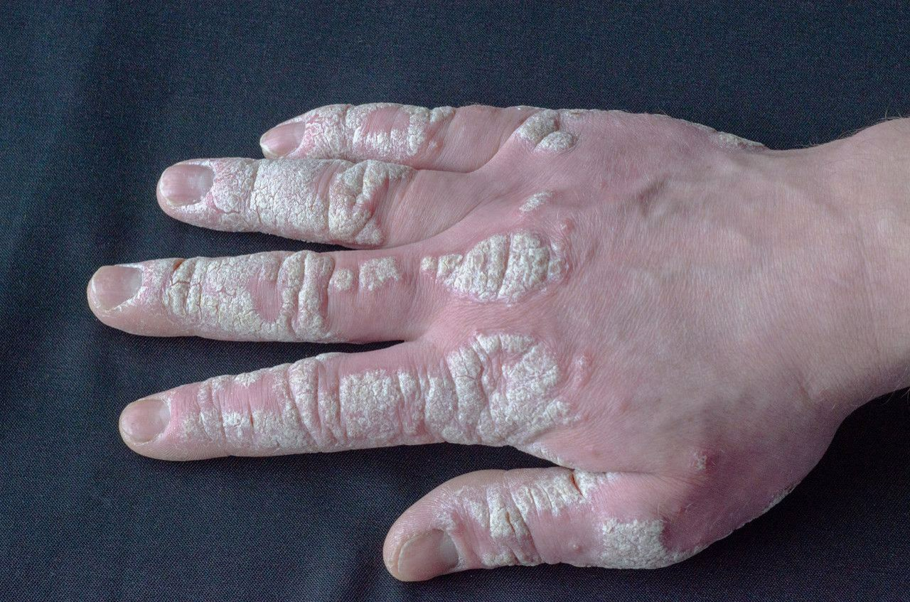 手指银屑病关节炎图片（手指银屑病关节炎多长时间消肿）