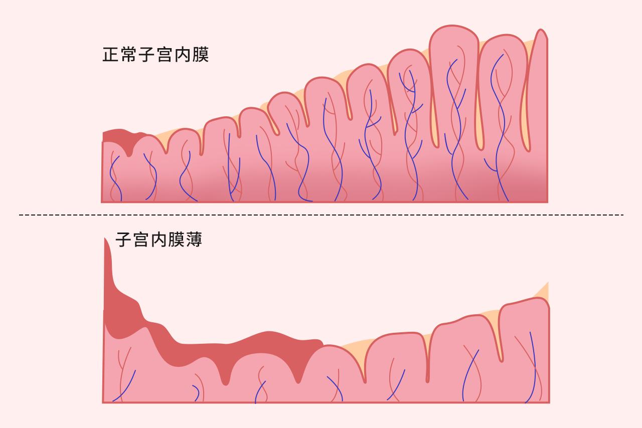 子宫内膜薄图片 子宫内膜薄长什么样