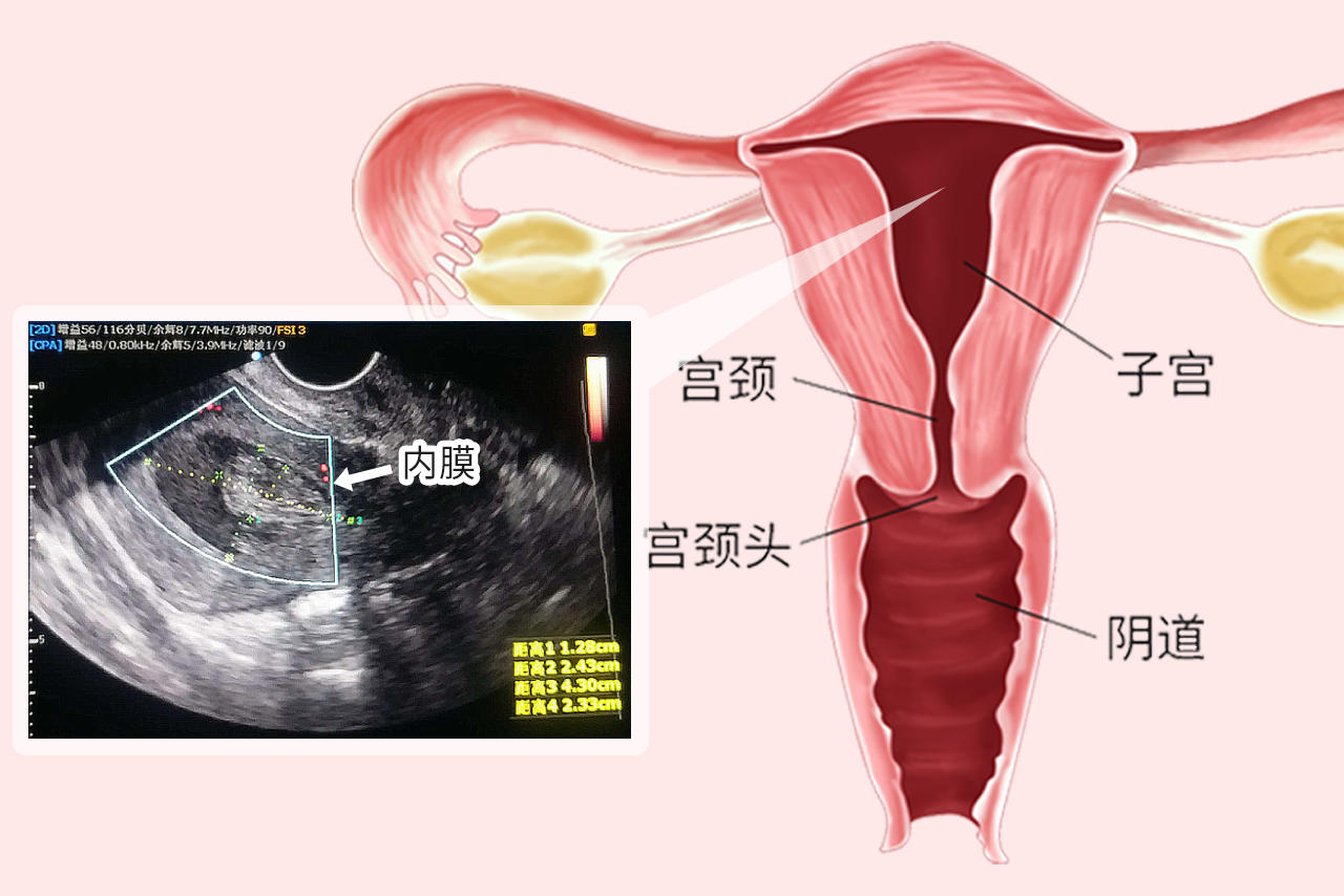 子宫内膜彩超图解（子宫内膜彩超图片）