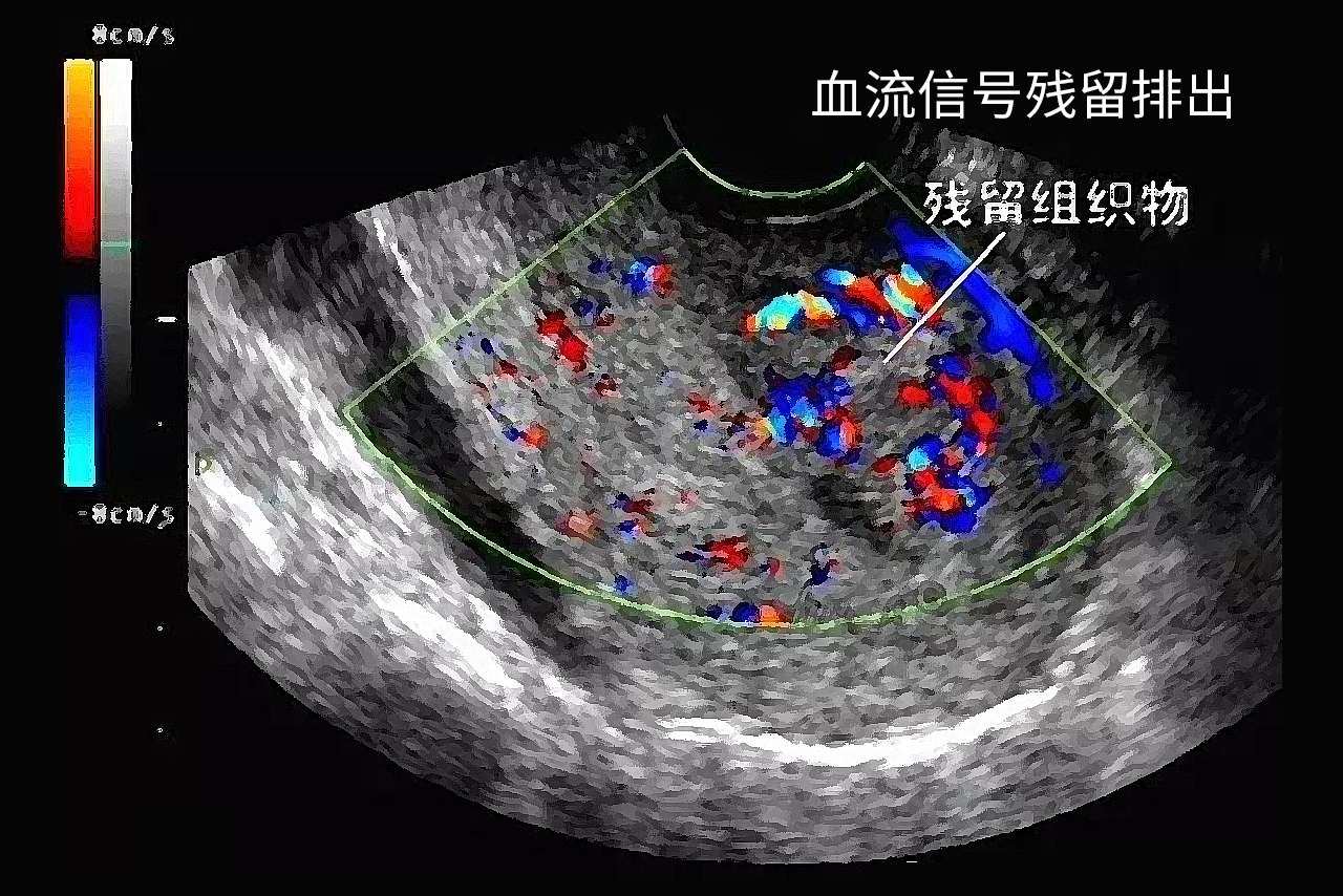 血流信号残留排出图片（有血流信号残留物不出血的原因）