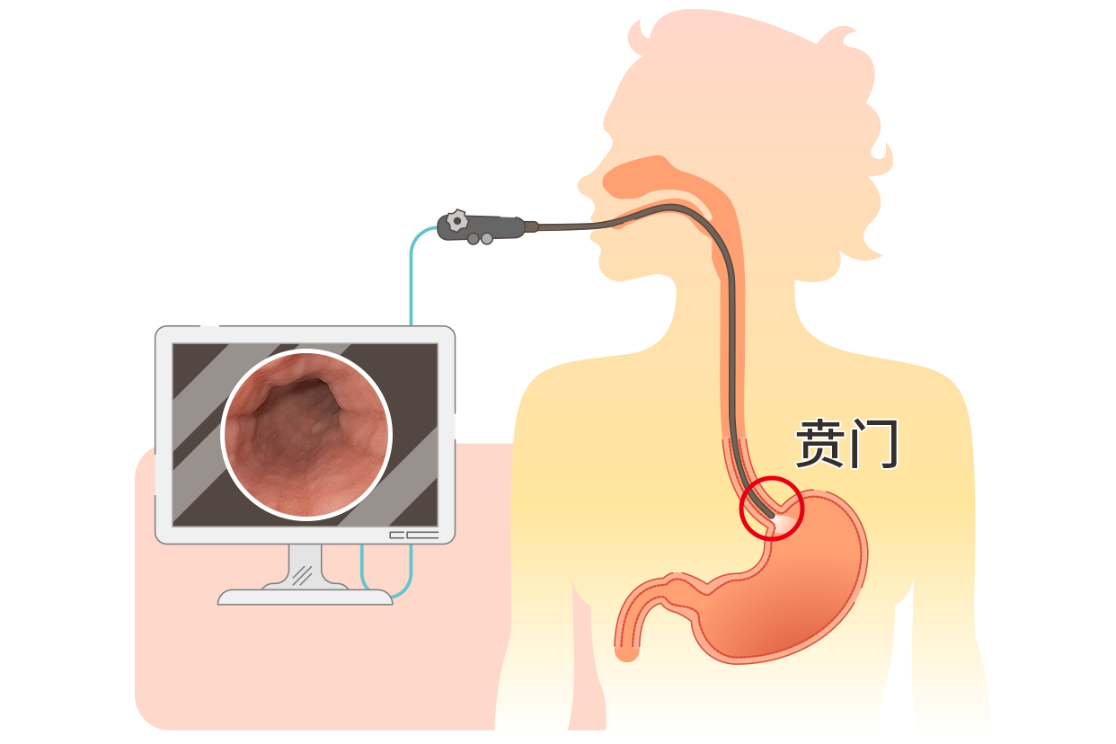 胃镜正常的贲门图片 胃镜贲门口图片