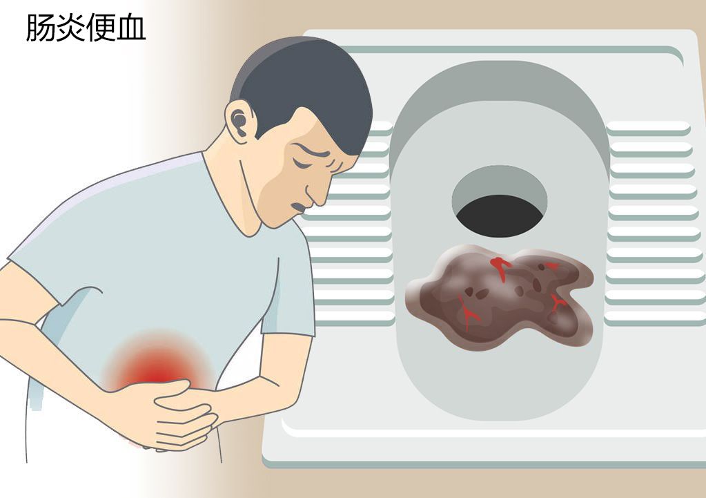 肠炎便血图片（肠炎大便图片）