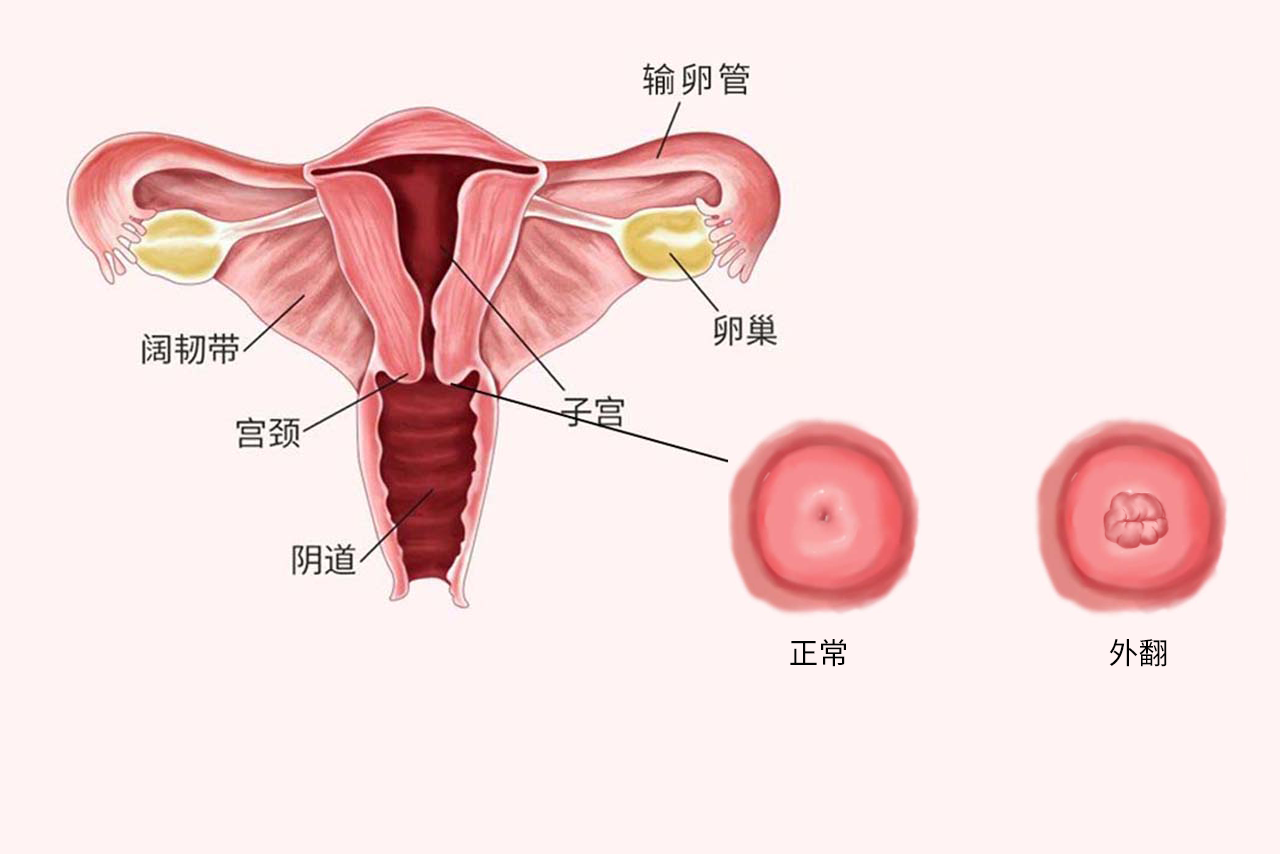 宮頸外翻圖片（宮頸外翻圖片怎么治療）