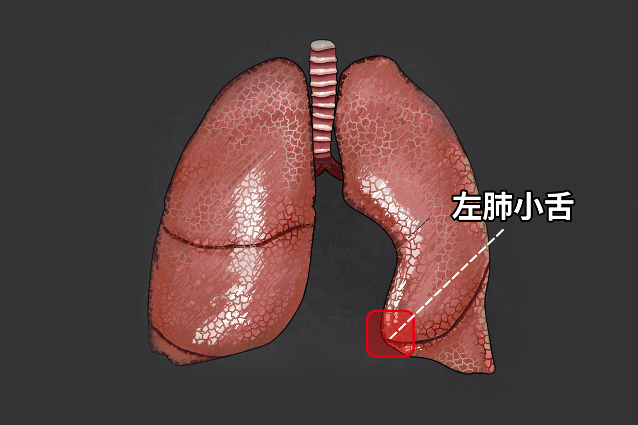 左肺小舌图片 左肺小舌位于左肺前缘