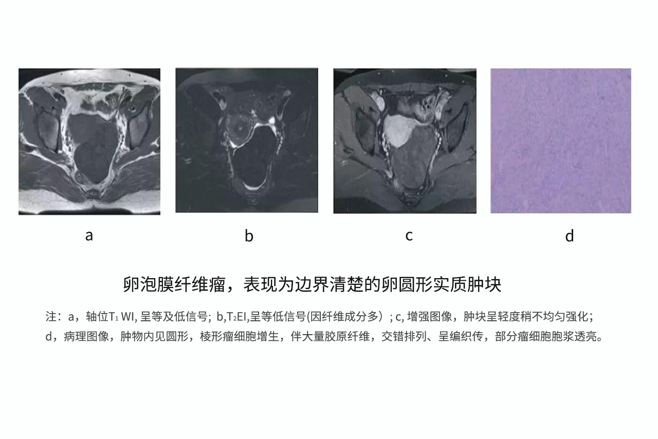 纤维卵泡膜细胞瘤图片 纤维卵泡膜细胞瘤图片大全