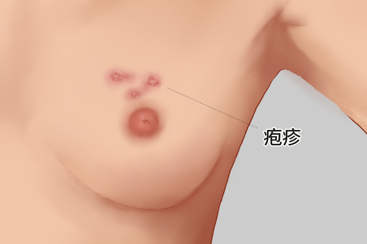 女性乳房长疱疹图样 乳房上生疱疹