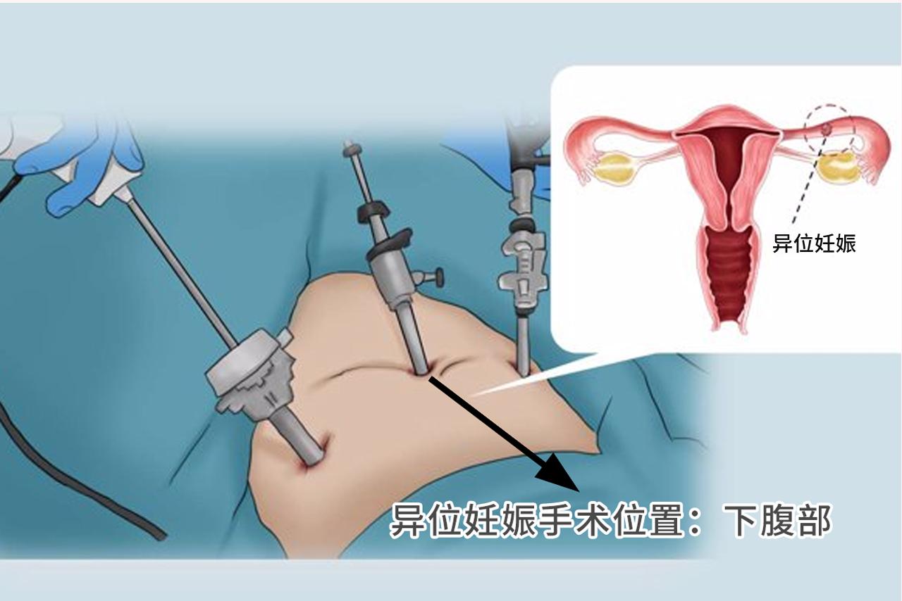 宫外孕手术在哪里开刀图