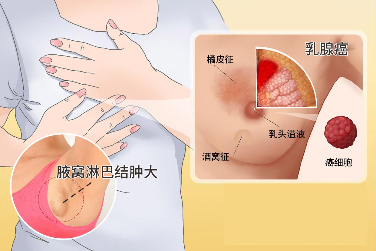 乳腺癌早期腋窩淋巴結(jié)腫大真人圖片