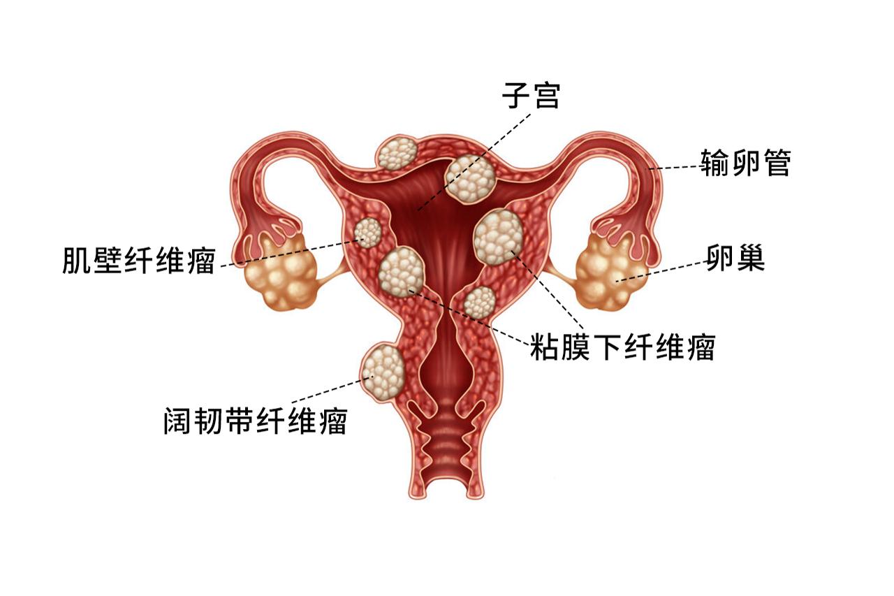 陰壁內(nèi)腫瘤的圖片