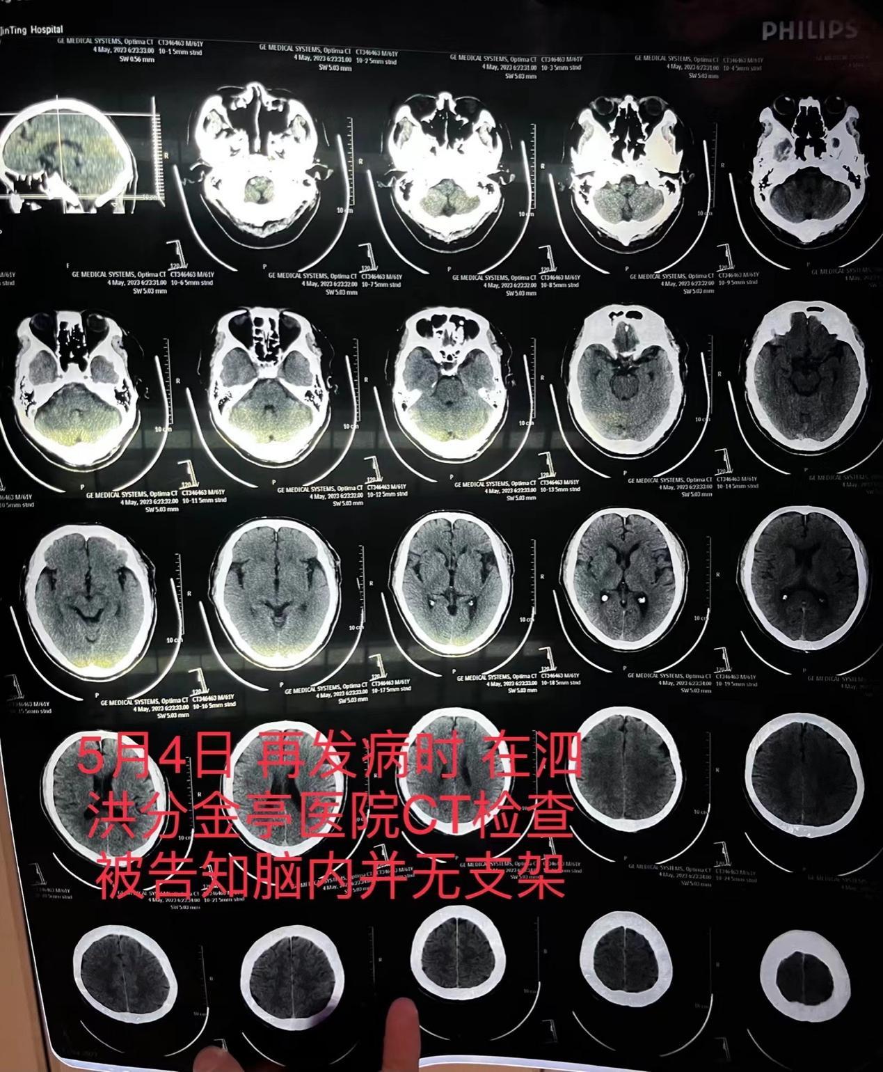 因脑梗去世老人曾被医生隐瞒未植入支架，医院和医生该担何责？